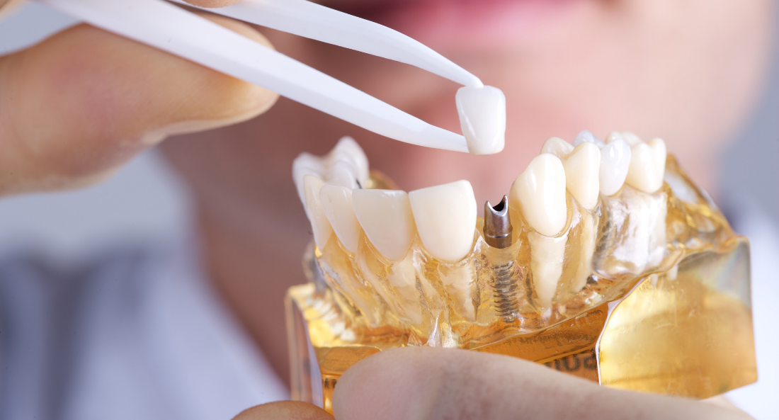 ​Replace Missing Teeth