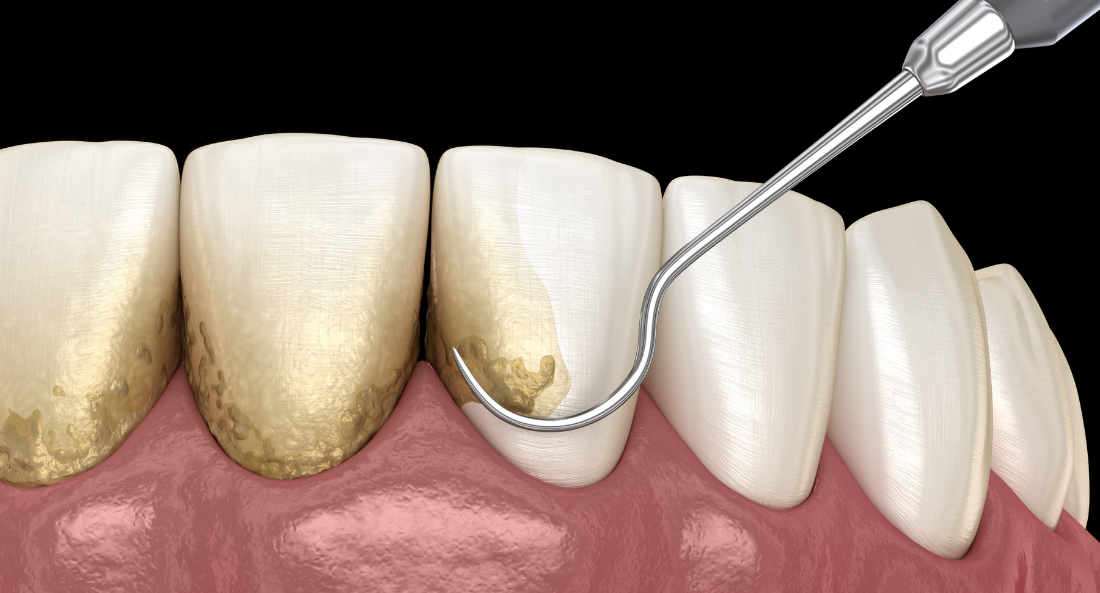 Periodontal Therapy