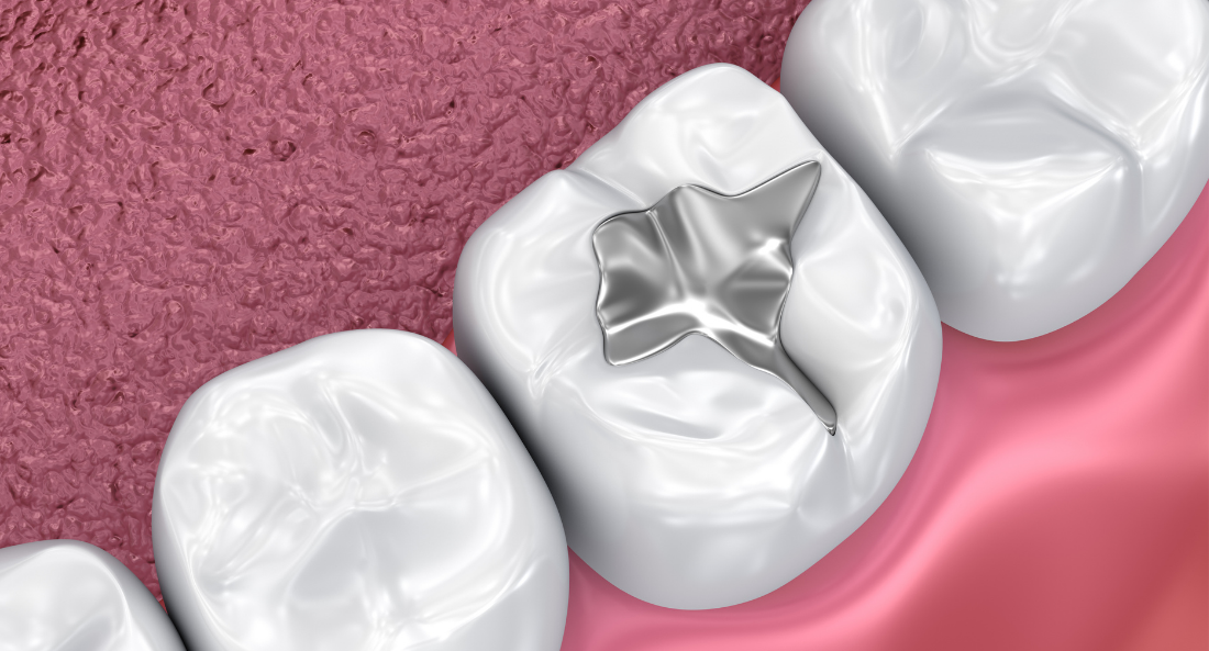 Αesthetic Fillings